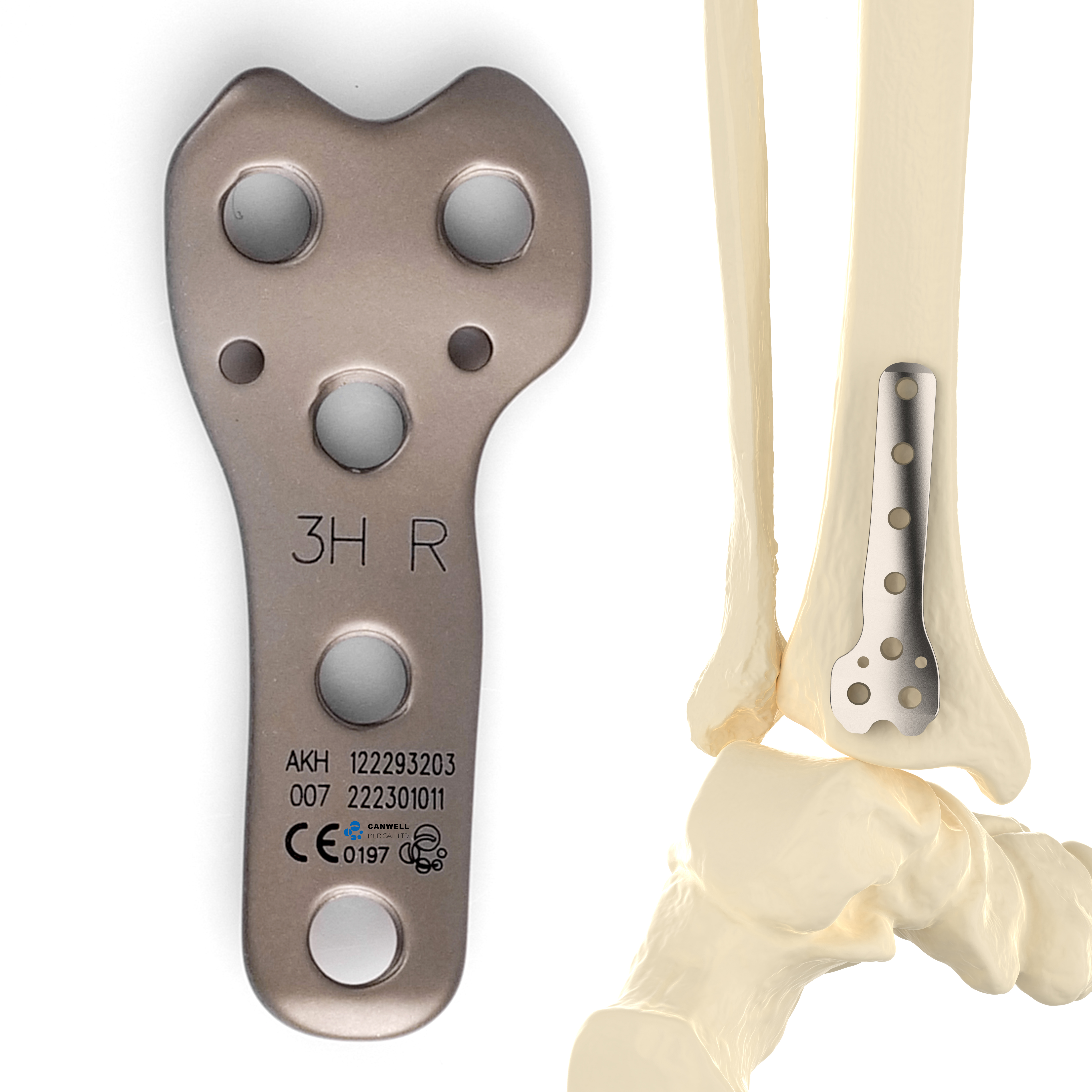 CANWELL Distal Tibial Titanium Locking Plate Posterior Limb Compression Orthopedic Trauma Fracture Implant CE OEM