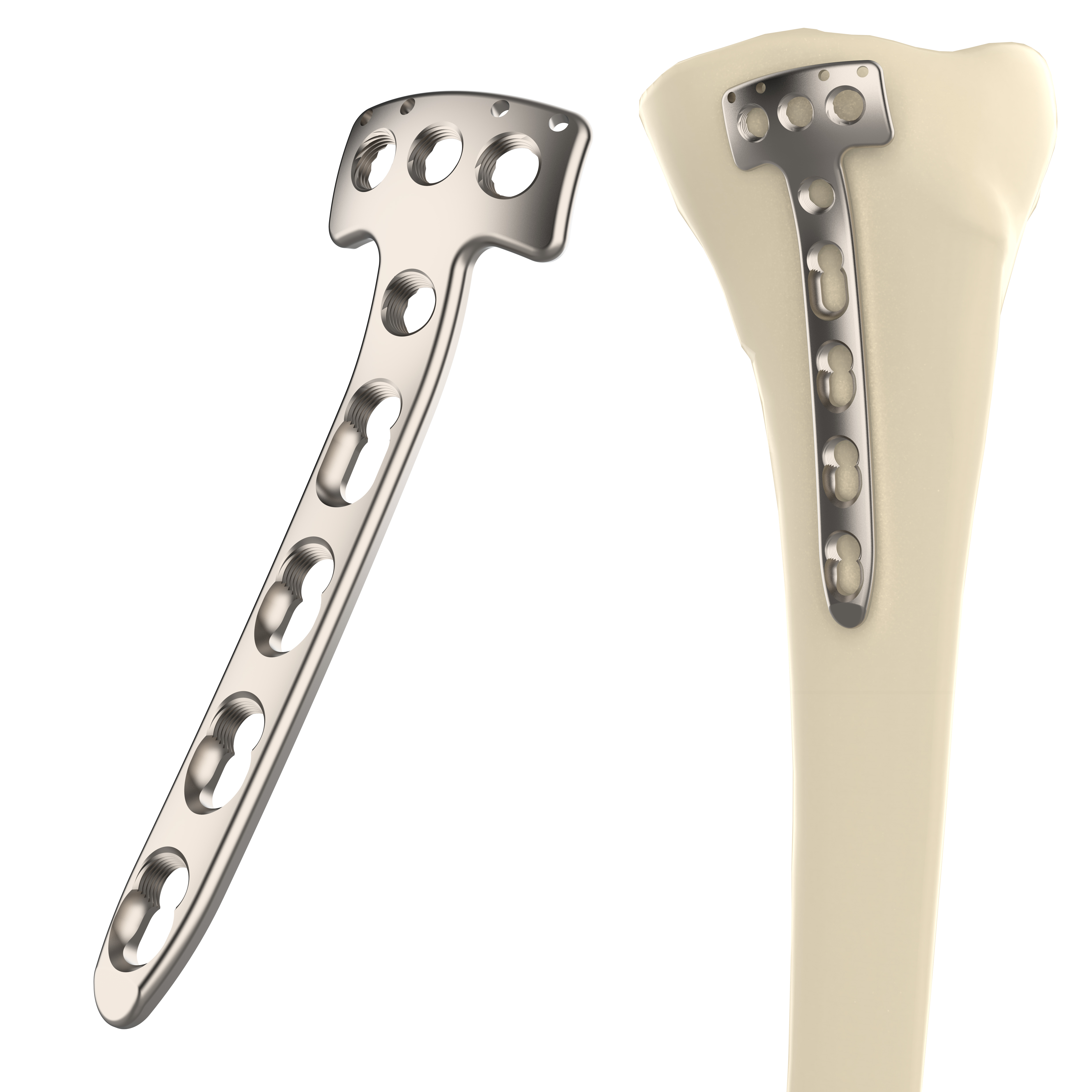 CANWELL Titanium Proximal Middle Tibial Locking Plate for Tibial Plateau Fracture Fixation ORIF Surgery Orthopedic OEM Supplier