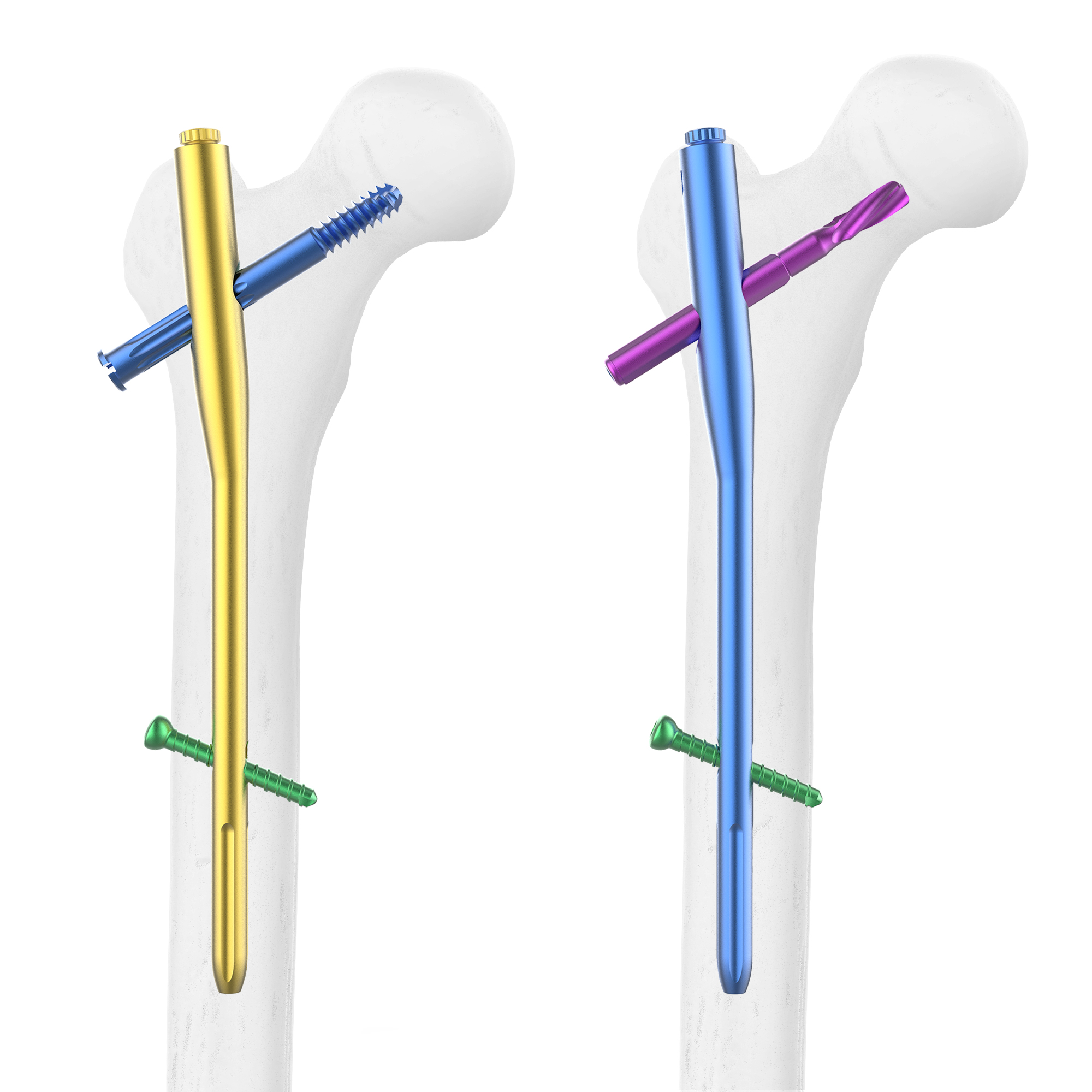 CANWELL Titanium Femoral Intramedullary Nails Interlocking Nail Femur PFNA Orthopedic Trauma Implants Bone Fracture
