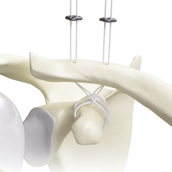 Acromioclavicular joint AC repair button