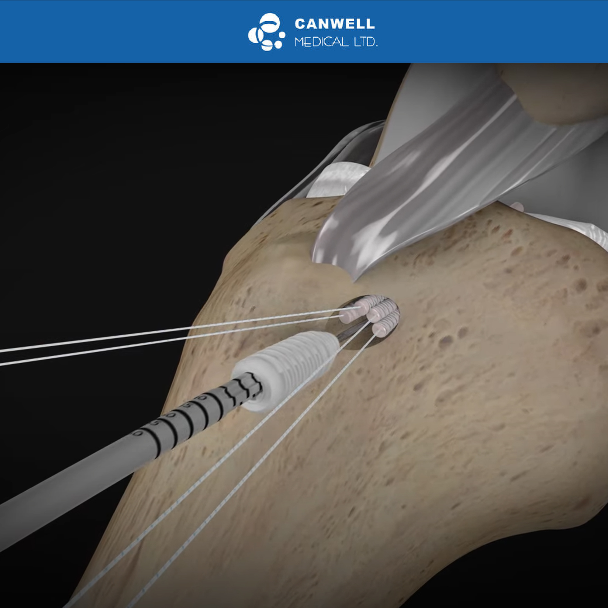 CANWELL Sports Medicine ACL Reconstruction ACL PCL Bioabsorbable Arthroscopy Surgery Peek Interference Screw