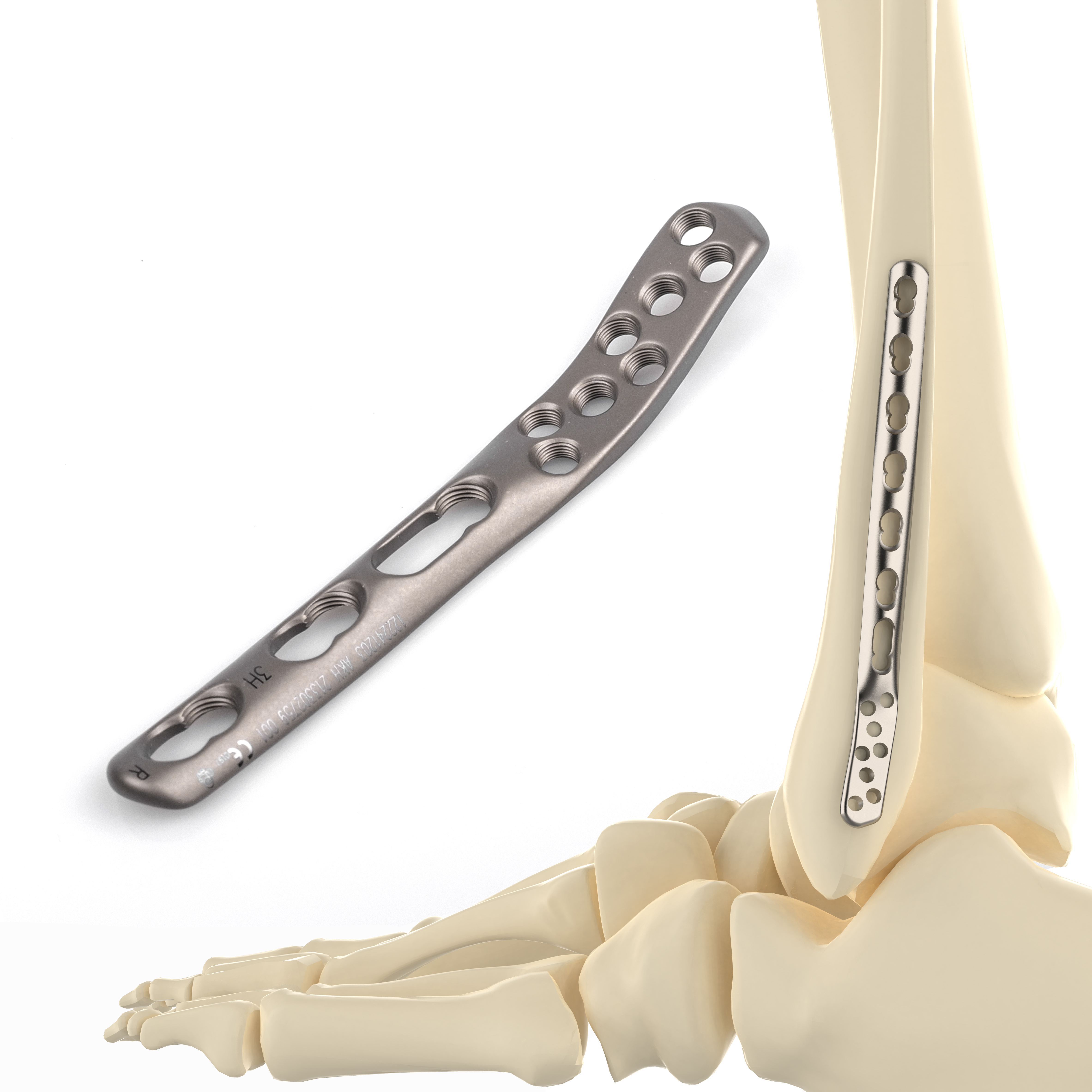 CANWELL Fibula Plate Titanium Posterolateral Distal Fibula Locking Plate
