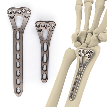 Titanium distal radius variable-angle volar locking plate