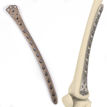 Distal lateral femoral titanium locking compression plate